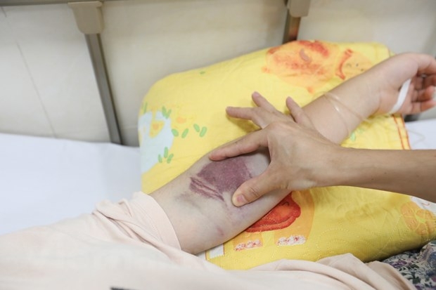 Hà Nội ghi nhận thêm nữ bệnh nhân 20 tuổi tử vong do sốt xuất huyết