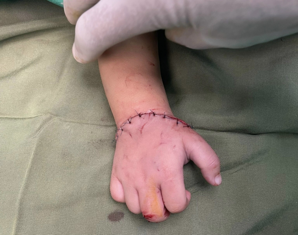 Phẫu thuật nối liền thành công bàn tay bị đứt rời cho bệnh nhi gần 18 tháng tuổi