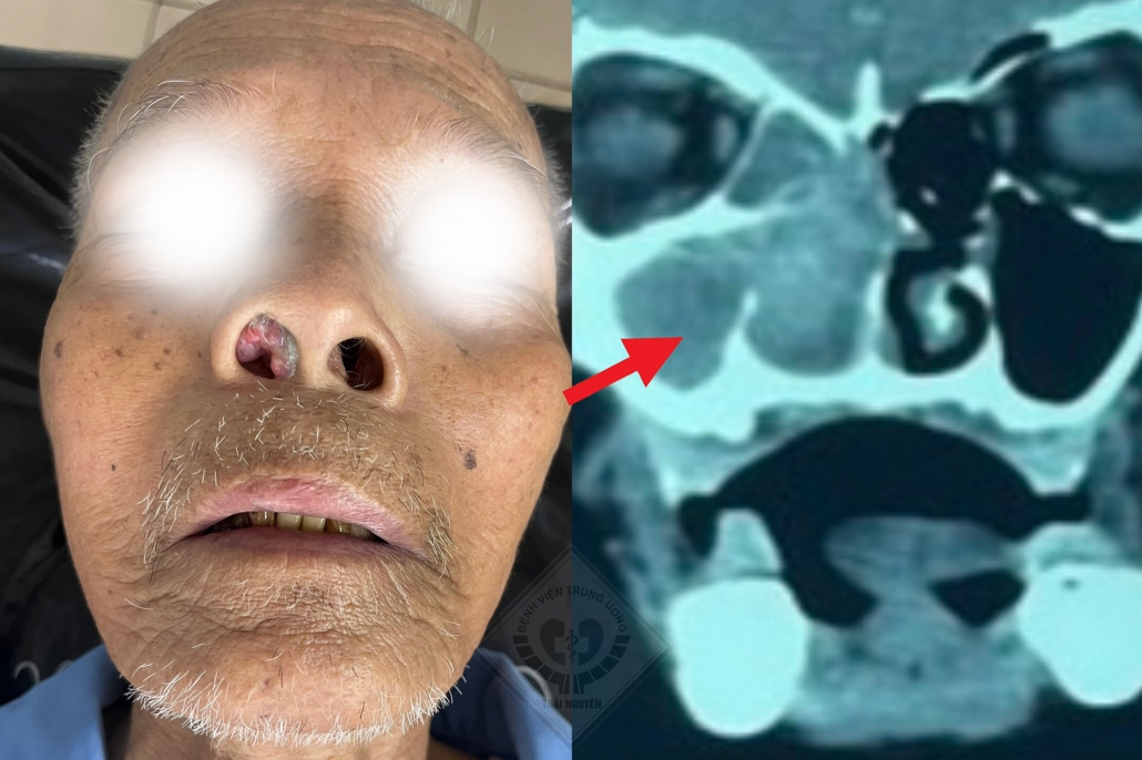 Bị ung thư mũi xoang, người bệnh 93 tuổi được phẫu thuật thành công