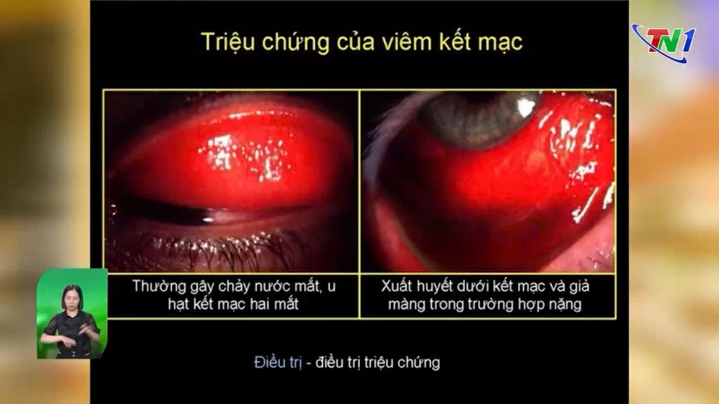 Chủ động phòng, chống bệnh đau mắt đỏ sau mưa lũ