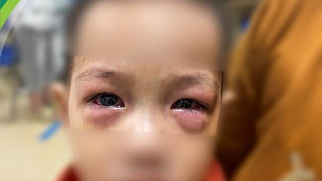 Bảo vệ trẻ em trước dịch đau mắt đỏ