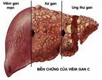 Việt Nam đạt được thoả thuận về thuốc chữa viêm gan C giá rẻ