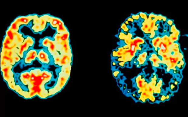 Lần đầu tiên vô hiệu hóa gen bệnh Alzheimer trong tế bào não người