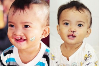 Miễn phí phẫu thuật sứt môi, hở hàm ếch cho trẻ nghèo miền Trung – Tây Nguyên