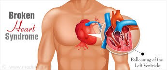 Hội chứng 'trái tim vỡ': Tổn thương tim do stress