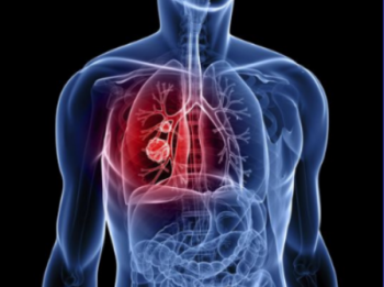 10 bác sĩ đầu ngành tư vấn miễn phí bệnh ung thư phổi