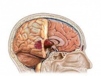 Những dấu hiệu cho thấy bạn có thể bị u não