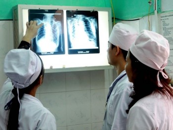 Việt Nam có số bệnh nhân mắc nấm phổi xâm lấn cao nhất thế giới