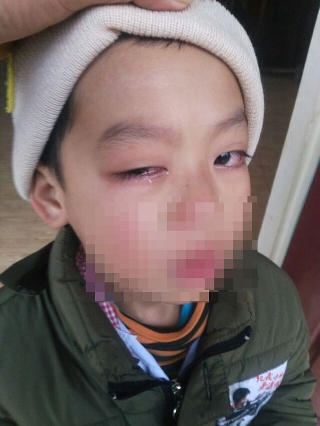 Lạng Sơn: Phụ huynh tố giáo viên dùng thước kẻ đánh học sinh lớp 1 đến hỏng mắt