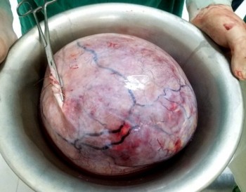 Bệnh viện huyện ở Yên Bái mổ lấy khối u nặng 5,5kg cho bệnh nhân