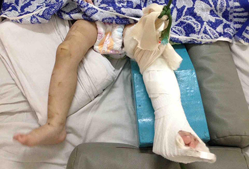 Bé gái một tuổi bị mẹ nuôi ở Sài Gòn đánh gãy chân