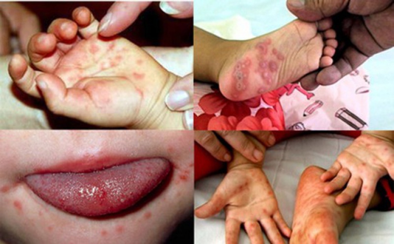 Nghệ An: Cảnh báo bùng phát bệnh tay chân miệng