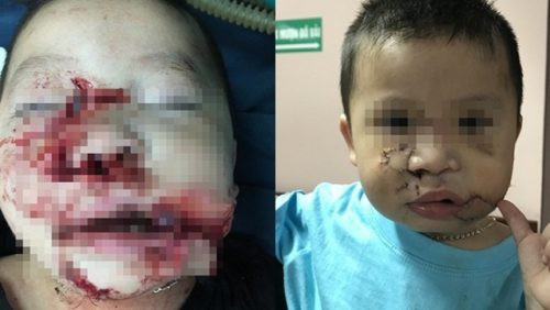 Hà Nội: bé 2 tuổi bị chó nhà cắn nát mặt