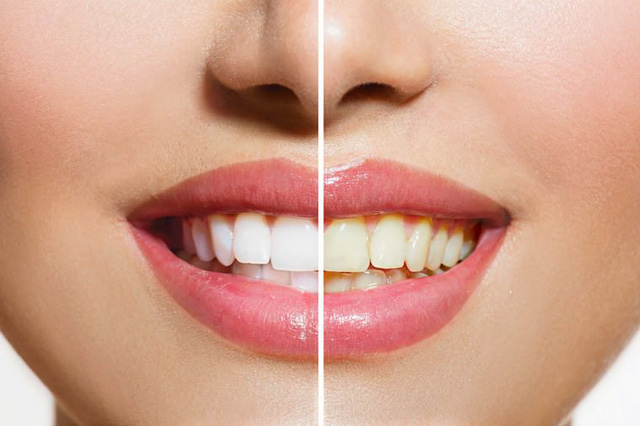 Răng màu vàng khoẻ hơn răng trắng sáng?