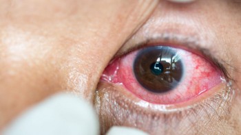Nguy cơ nhiễm trùng mắt nghiêm trọng từ kính áp tròng